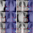 The tumor localization/visualization results obtained by the proposed AI algorithm. Original chest x-ray images with a lesion (red circle = radiologists’ annotation of the lesion location) and AI's lesion localization result. These examples demonstrate that the proposed technique can successfully detect humeral tumors. Image and caption courtesy of Radiology: Artificial Intelligence.