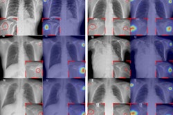 The tumor localization/visualization results obtained by the proposed AI algorithm. Original chest x-ray images with a lesion (red circle = radiologists’ annotation of the lesion location) and AI's lesion localization result. These examples demonstrate that the proposed technique can successfully detect humeral tumors. Image and caption courtesy of Radiology: Artificial Intelligence.