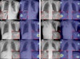 The tumor localization/visualization results obtained by the proposed AI algorithm. Original chest x-ray images with a lesion (red circle = radiologists’ annotation of the lesion location) and AI's lesion localization result. These examples demonstrate that the proposed technique can successfully detect humeral tumors. Image and caption courtesy of Radiology: Artificial Intelligence.