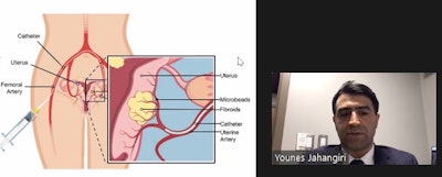 Younes Jahangiri, MD, of Michigan State University, described a procedure called uterine artery embolization at a March 19 media briefing held by the Society of Interventional Radiology.