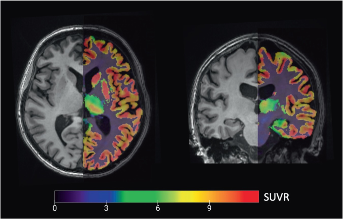 PET/MRI images used in the analysis: Axial (left, through the prefrontal volume-of-interest) and coronal (right, through the hippocampal volume-of-interest) overlay of a partial volume corrected carbon-11 UCB-J PET image (right subparts) registered to the anatomical T1-weighted MRI background for delineation.