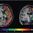 PET/MRI images used in the analysis: Axial (left, through the prefrontal volume-of-interest) and coronal (right, through the hippocampal volume-of-interest) overlay of a partial volume corrected carbon-11 UCB-J PET image (right subparts) registered to the anatomical T1-weighted MRI background for delineation.