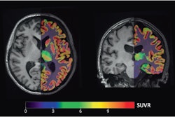 PET/MRI images used in the analysis: Axial (left, through the prefrontal volume-of-interest) and coronal (right, through the hippocampal volume-of-interest) overlay of a partial volume corrected carbon-11 UCB-J PET image (right subparts) registered to the anatomical T1-weighted MRI background for delineation.