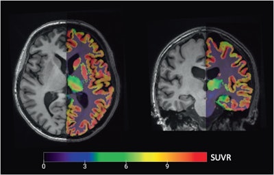 PET/MRI images used in the analysis: Axial (left, through the prefrontal volume-of-interest) and coronal (right, through the hippocampal volume-of-interest) overlay of a partial volume corrected carbon-11 UCB-J PET image (right subparts) registered to the anatomical T1-weighted MRI background for delineation. PET/MRI images used in the analysis: Axial (left, through the prefrontal volume-of-interest) and coronal (right, through the hippocampal volume-of-interest) overlay of a partial volume corrected carbon-11 UCB-J PET image (right subparts) registered to the anatomical T1-weighted MRI background for delineation.
