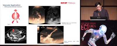 Dean Huang, MD, from King's College London highlights how contrast-enhance ultrasound (CEUS) has a wide variety of applications in diagnostic and interventional settings. Pictured, he explains how it can better visualize endoleaks.