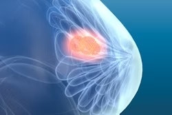 Breast Update
