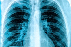 Chest X Ray
