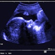 Fetal Ultrasound 400