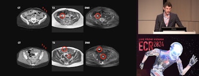Max Lahaye, MD, of the Netherlands Cancer Institute in Amsterdam presents findings on the clinical impact of dedicated MR staging of ovarian cancer patients during ECR 2024.