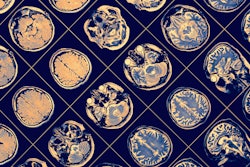 Mri Brain