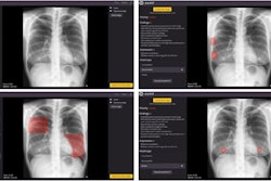 Image of patient (upper-left) in which, according to the radiologist's report, there is only consolidation, but the algorithm detects an abnormal rib (upper-right), consolidation (lower-left), and two nodules (lower-right). It is worth noting the confusion of a consolidation with mammary tissue and of two nodules with the two mammary areolae. Image courtesy of Scientific Reports.