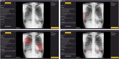 Image of patient (upper-left) in which, according to the radiologist's report, there is only consolidation, but the algorithm detects an abnormal rib (upper-right), consolidation (lower-left), and two nodules (lower-right). It is worth noting the confusion of a consolidation with mammary tissue and of two nodules with the two mammary areolae. Image courtesy of Scientific Reports.