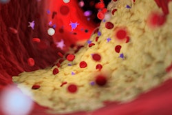 Plaque Artery