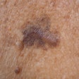 Skin Cancer 400