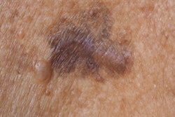Skin Cancer 400