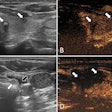 Ultrasound images in a 57-year-old female patient with multifocal papillary thyroid carcinoma. (A) Routine ultrasound scan shows two hypoechoic papillary thyroid carcinoma nodules (arrows) in the left lobe. (B) Preablation contrast-enhanced ultrasound image shows hypoenhancement in the arterial phase (arrows). (C) Isolating fluid (black arrow) is used to protect the muscles beside the nodule (white arrow) during the ablation. (D) Postablation contrast-enhanced ultrasound image shows no enhancement in the original tumor zone (arrows). Image courtesy of the RSNA.