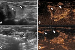 Ultrasound images in a 57-year-old female patient with multifocal papillary thyroid carcinoma. (A) Routine ultrasound scan shows two hypoechoic papillary thyroid carcinoma nodules (arrows) in the left lobe. (B) Preablation contrast-enhanced ultrasound image shows hypoenhancement in the arterial phase (arrows). (C) Isolating fluid (black arrow) is used to protect the muscles beside the nodule (white arrow) during the ablation. (D) Postablation contrast-enhanced ultrasound image shows no enhancement in the original tumor zone (arrows). Image courtesy of the RSNA.
