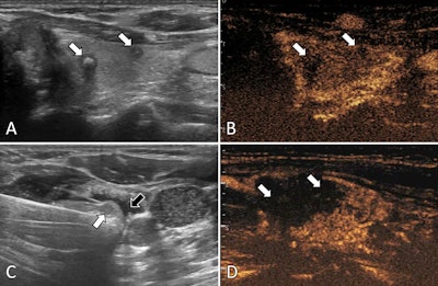 Ultrasound images in a 57-year-old female patient with multifocal papillary thyroid carcinoma. (A) Routine ultrasound scan shows two hypoechoic papillary thyroid carcinoma nodules (arrows) in the left lobe. (B) Preablation contrast-enhanced ultrasound image shows hypoenhancement in the arterial phase (arrows). (C) Isolating fluid (black arrow) is used to protect the muscles beside the nodule (white arrow) during the ablation. (D) Postablation contrast-enhanced ultrasound image shows no enhancement in the original tumor zone (arrows). Image courtesy of the RSNA.