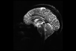 2024 04 03 Brain Scan At 11 7 Tesla