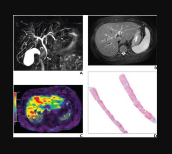 2024 04 19 7 Year Old Boy With Autoimmune Sclerosing Cholangitis