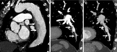 Flow artifact from slow blood flow along the inner curves of arteries in two patients. (A) Sagittal oblique MPR from a CT examination timed off the aorta in a 78-year-old man with chest pain shows smokelike nonuniform opacification along the inner curve of the descending aorta (arrows), a common location for flow artifacts on CT images. (B, C) Sagittal oblique MPR (B) of the left-sided pulmonary arterial tree in a 76-year-old man with chest pain shows smokelike nonuniform opacification along the inner curve of the posterior basal segment left lower lobe arteries (arrows in B). These findings resolved (arrows in C) on a subsequent CT image (C) with a 70-second delay. Image and caption courtesy of the RSNA.