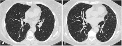 Axial chest CT scans (0.75-mm section thickness, reconstructed with b31f kernel) at (A) visit 1 and (B) visit 2 at the level of the takeoff of the right middle bronchus of a participant with 1.2 annual percentage quantitative interstitial abnormality progression. The female participant was 62 years old at [baseline] visit 1 and 67 years old at [follow-up] and a current smoker at both visits, with a 47.5 pack-year history at [follow-up]. This participant had four subsequent acute respiratory disease (ARD) events and three subsequent severe ARD events. Images and caption courtesy of the RSNA.