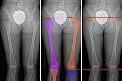 2024 04 30 Scoliosis Ai Thumbnail