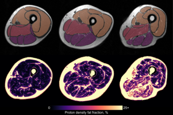 2024 04 30 Tracking Muscle Fat Mri Thumbnail