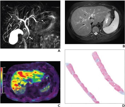 7-year-old boy with autoimmune sclerosing cholangitis and METAVIR stage 3 fibrosis on liver biopsy. (A) Coronal maximum intensity projection MR cholangiopancreatography (MRCP) image shows multiple intrahepatic strictures (dotted arrows), narrowing of common bile duct (solid arrow), and mild dilation of central biliary tree (dashed arrow). (B) Axial T2-weighted fast spin echo MR image with fat suppression shows enlarged liver with increased T2-weighted signal intensity. (C) Axial MR elastogram image shows heterogeneous appearance of liver with abnormal stiffening (mean liver stiffness, 6.55 kPa). (D) Tissue specimen (Mason trichrome stain; digital scan at 1x magnification) from percutaneous liver biopsy shows abnormally increased fibrosis (blue). Image and caption courtesy of the AJR.