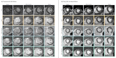 Visualization CGE of varying generated contrasts (gray, intermediate and bright blood) compared with LGE for two AMI patients. (A) A patient with large transmural LGE; (B) A patient with tiny LGE on basal slices.