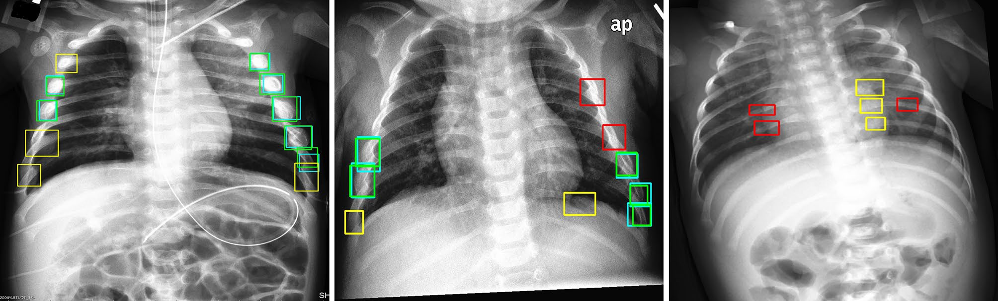 Test set images with ground truth (teal, red) and model predictions (green, yellow), with true positives (green), false positives (yellow), and false negatives (red). Predictions from the 6x-YOLOv5 ensemble trained on histogram equalized input images with a y = 0.2 avalanche scheme, achieving 0.536 precision, 0.795 recall, and 0.723 F2 score. Image and caption courtesy of Scientific Reports.