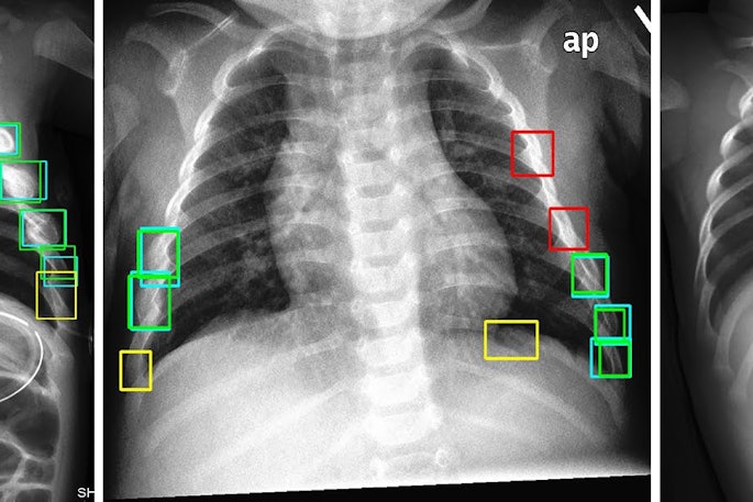 Test set images with ground truth (teal, red) and model predictions (green, yellow), with true positives (green), false positives (yellow), and false negatives (red). Predictions from the 6x-YOLOv5 ensemble trained on histogram equalized input images with a y = 0.2 avalanche scheme, achieving 0.536 precision, 0.795 recall, and 0.723 F2 score. Image and caption courtesy of Scientific Reports.
