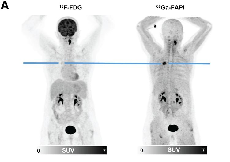 F-18 FDG and Ga-68 FAPI-46 images of a 51-year-old woman with adenocarcinoma with lepidic growth pattern in right upper lobe. (A) Maximum-intensity-projection PET images. The lesion had F-18 FDG uptake below blood pool level but was strongly Ga-68 FAPI-46-positive. CT-guided biopsy led to pathologic diagnosis of adenocarcinoma, and the patient was treated by stereotactic body radiation therapy because of functional inoperability. Image courtesy of the Journal of Nuclear Medicine.