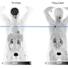F-18 FDG and Ga-68 FAPI-46 images of a 51-year-old woman with adenocarcinoma with lepidic growth pattern in right upper lobe. (A) Maximum-intensity-projection PET images. The lesion had F-18 FDG uptake below blood pool level but was strongly Ga-68 FAPI-46-positive. CT-guided biopsy led to pathologic diagnosis of adenocarcinoma, and the patient was treated by stereotactic body radiation therapy because of functional inoperability. Image courtesy of the Journal of Nuclear Medicine.