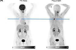 F-18 FDG and Ga-68 FAPI-46 images of a 51-year-old woman with adenocarcinoma with lepidic growth pattern in right upper lobe. (A) Maximum-intensity-projection PET images. The lesion had F-18 FDG uptake below blood pool level but was strongly Ga-68 FAPI-46-positive. CT-guided biopsy led to pathologic diagnosis of adenocarcinoma, and the patient was treated by stereotactic body radiation therapy because of functional inoperability. Image courtesy of the Journal of Nuclear Medicine.