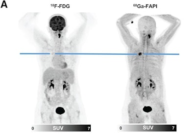 Изображения F-18 FDG и Ga-68 FAPI-46 51-летней женщины с аденокарциномой с лепидным характером роста в правой верхней доле. (A) ПЭТ-изображения в проекции максимальной интенсивности. Поражение имело поглощение F-18 FDG ниже уровня пула крови, но было сильно положительным по Ga-68 FAPI-46. Биопсия под контролем КТ привела к патоморфологическому диагнозу аденокарциномы, и пациенту была назначена стереотаксическая лучевая терапия тела из-за функциональной неоперабельности. Изображение предоставлено Журналом ядерной медицины.