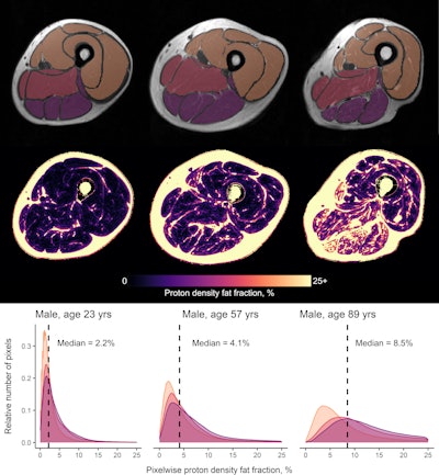 Proton density fat fraction (PDFF) in the left thigh. Columns, from left to right, represent data acquired in 23-, 57-, and 89-year-old male participants, respectively. The top row shows T1-weighted images from the mid-thigh with posterior, medial, and anterior compartment segmentations overlaid. The middle row shows PDFF maps generated from Dixon data taken at the same position as the T1-weighted data; the color scale indicates PDFF values in percent. The bottom row shows density plots of pixelwise PDFF per compartment. Median PDFF increases with increasing age. Image and caption courtesy of coauthor Donnie Cameron, PhD, of Radboud University in Nijmegen, the Netherlands.