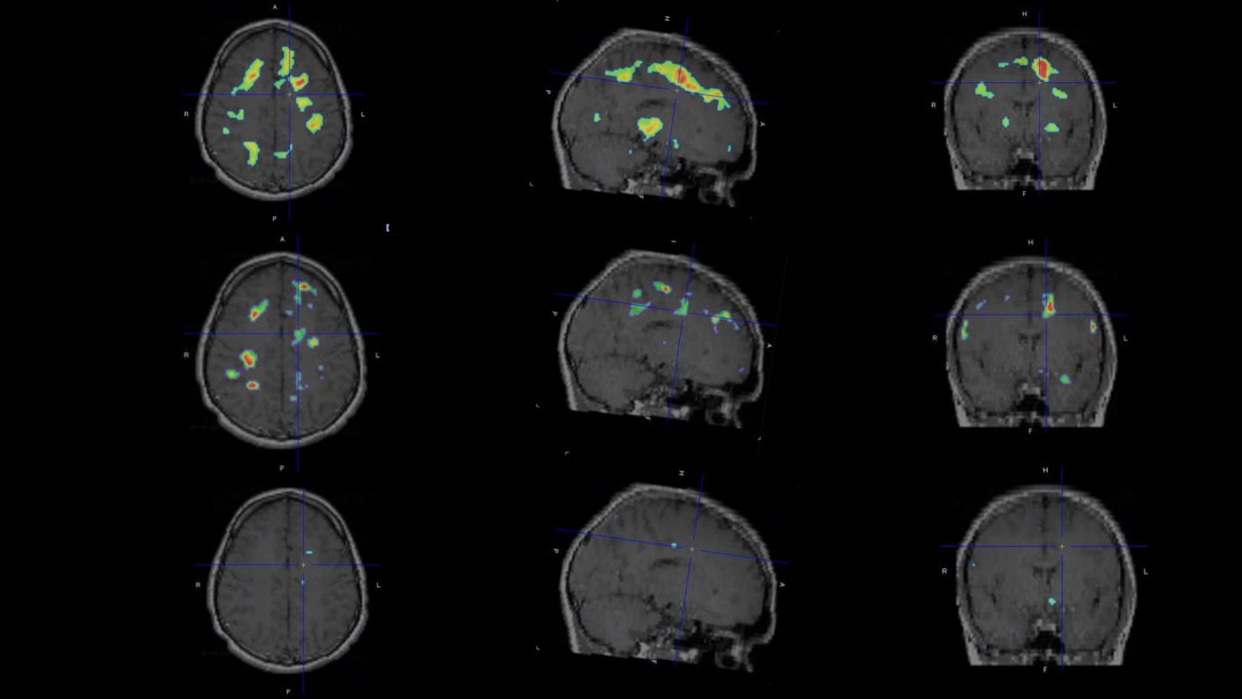 Individualized parametric z-score maps of the brain showing glial activity load in the brain, compared among individuals with secondary progressive MS (SPMS) (top row), relapsing-remitting MS (RRMS) (middle row), and a healthy control (HC) (bottom row) in transaxial, sagittal, and coronal sections. Image courtesy of Clinical Nuclear Medicine.