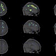 Individualized parametric z-score maps of the brain showing glial activity load in the brain, compared among individuals with secondary progressive MS (SPMS) (top row), relapsing-remitting MS (RRMS) (middle row), and a healthy control (HC) (bottom row) in transaxial, sagittal, and coronal sections. Image courtesy of Clinical Nuclear Medicine.