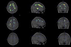 Individualized parametric z-score maps of the brain showing glial activity load in the brain, compared among individuals with secondary progressive MS (SPMS) (top row), relapsing-remitting MS (RRMS) (middle row), and a healthy control (HC) (bottom row) in transaxial, sagittal, and coronal sections. Image courtesy of Clinical Nuclear Medicine.