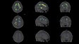 Individualized parametric z-score maps of the brain showing glial activity load in the brain, compared among individuals with secondary progressive MS (SPMS) (top row), relapsing-remitting MS (RRMS) (middle row), and a healthy control (HC) (bottom row) in transaxial, sagittal, and coronal sections. Image courtesy of Clinical Nuclear Medicine.