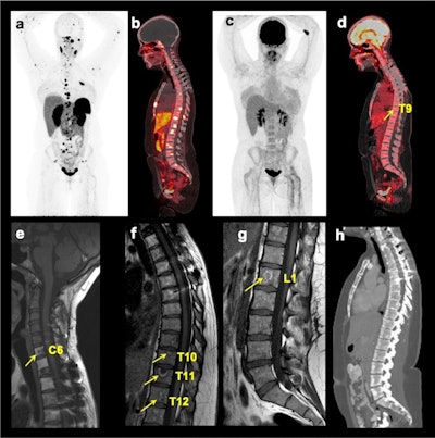 Multimodality imaging of spinal bone metastases in a participant with pheochromocytoma and paraganglioma. The images of (a) whole-body Ga-68 DOTATATE anterior maximum intensity projection (MIP) and (b) fused sagittal PET/CT; F-18 FDG MIP (c) and fused sagittal PET/CT (d); T1-weighted sagittal MRI of the cervical (e), thoracic (f), and lumbar (g) spine, and contrast-enhanced CT (h sagittal) of a 25-year-old woman. This figure shows superiority of Ga-68 DOTATATE PET/CT in the detection of additional spinal bone metastases at C2, C5, C7, T1-2, T4-8, L2, and L5 compared to F-18 FDG-PET/CT in detecting spinal bone metastases at T9 (arrow on fused sagittal image and not appreciated on MIP image) and L4 (not appreciated on MIP and fused sagittal images), and MRI spine at C6, T10-12, and L1 (arrows), respectively. The whole-body CT was read negative for any spinal bone metastases. This participant did not undergo whole-body MRI. Image and caption courtesy of European Radiology.