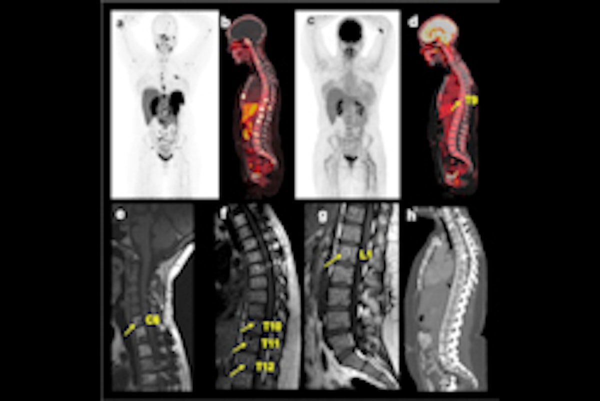PET/CT superior to MRI for detecting spinal bone metastases | AuntMinnie