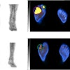 Examples in two patients. (Top) Abnormal leukocyte accumulation was observed in the right 1st to 5th toes, with the radioactive lesions extending to the bone, indicating osteomyelitis (left panel, MIP image; right panel, axial SPECT/CT). Two spherical VOIs were drawn on diabetic foot infections (DFIs) and the highest SUVmax was 4.2 (higher than the cutoff of 1.1) Despite intensive treatment, the infection progressed, leading to the patient undergoing right below knee amputation 43 days after SPECT/CT. (Bottom) Mild focal abnormal leukocyte accumulation was detected in the right 3rd and 4th toes. The lesions were in contact with the bone, which raised a suspicion of osteomyelitis (left panel, MIP image; right panel, axial SPECT/CT). A circular VOI was drawn on DFIs and the SUVmax was 1.0 (lower than the cutoff of 1.1). After 10 weeks of antibiotic treatment, the infection was successfully resolved, and the foot was preserved. Image and caption courtesy of Scientific Reports.