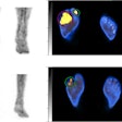 Examples in two patients. (Top) Abnormal leukocyte accumulation was observed in the right 1st to 5th toes, with the radioactive lesions extending to the bone, indicating osteomyelitis (left panel, MIP image; right panel, axial SPECT/CT). Two spherical VOIs were drawn on diabetic foot infections (DFIs) and the highest SUVmax was 4.2 (higher than the cutoff of 1.1) Despite intensive treatment, the infection progressed, leading to the patient undergoing right below knee amputation 43 days after SPECT/CT. (Bottom) Mild focal abnormal leukocyte accumulation was detected in the right 3rd and 4th toes. The lesions were in contact with the bone, which raised a suspicion of osteomyelitis (left panel, MIP image; right panel, axial SPECT/CT). A circular VOI was drawn on DFIs and the SUVmax was 1.0 (lower than the cutoff of 1.1). After 10 weeks of antibiotic treatment, the infection was successfully resolved, and the foot was preserved. Image and caption courtesy of Scientific Reports.