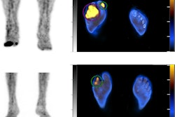 Examples in two patients. (Top) Abnormal leukocyte accumulation was observed in the right 1st to 5th toes, with the radioactive lesions extending to the bone, indicating osteomyelitis (left panel, MIP image; right panel, axial SPECT/CT). Two spherical VOIs were drawn on diabetic foot infections (DFIs) and the highest SUVmax was 4.2 (higher than the cutoff of 1.1) Despite intensive treatment, the infection progressed, leading to the patient undergoing right below knee amputation 43 days after SPECT/CT. (Bottom) Mild focal abnormal leukocyte accumulation was detected in the right 3rd and 4th toes. The lesions were in contact with the bone, which raised a suspicion of osteomyelitis (left panel, MIP image; right panel, axial SPECT/CT). A circular VOI was drawn on DFIs and the SUVmax was 1.0 (lower than the cutoff of 1.1). After 10 weeks of antibiotic treatment, the infection was successfully resolved, and the foot was preserved. Image and caption courtesy of Scientific Reports.