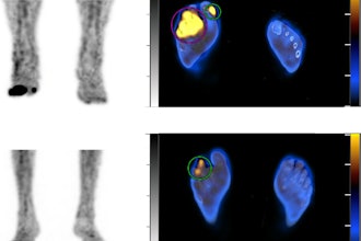 Examples in two patients. (Top) Abnormal leukocyte accumulation was observed in the right 1st to 5th toes, with the radioactive lesions extending to the bone, indicating osteomyelitis (left panel, MIP image; right panel, axial SPECT/CT). Two spherical VOIs were drawn on diabetic foot infections (DFIs) and the highest SUVmax was 4.2 (higher than the cutoff of 1.1) Despite intensive treatment, the infection progressed, leading to the patient undergoing right below knee amputation 43 days after SPECT/CT. (Bottom) Mild focal abnormal leukocyte accumulation was detected in the right 3rd and 4th toes. The lesions were in contact with the bone, which raised a suspicion of osteomyelitis (left panel, MIP image; right panel, axial SPECT/CT). A circular VOI was drawn on DFIs and the SUVmax was 1.0 (lower than the cutoff of 1.1). After 10 weeks of antibiotic treatment, the infection was successfully resolved, and the foot was preserved. Image and caption courtesy of Scientific Reports.