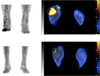 Examples in two patients. (Top) Abnormal leukocyte accumulation was observed in the right 1st to 5th toes, with the radioactive lesions extending to the bone, indicating osteomyelitis (left panel, MIP image; right panel, axial SPECT/CT). Two spherical VOIs were drawn on diabetic foot infections (DFIs) and the highest SUVmax was 4.2 (higher than the cutoff of 1.1) Despite intensive treatment, the infection progressed, leading to the patient undergoing right below knee amputation 43 days after SPECT/CT. (Bottom) Mild focal abnormal leukocyte accumulation was detected in the right 3rd and 4th toes. The lesions were in contact with the bone, which raised a suspicion of osteomyelitis (left panel, MIP image; right panel, axial SPECT/CT). A circular VOI was drawn on DFIs and the SUVmax was 1.0 (lower than the cutoff of 1.1). After 10 weeks of antibiotic treatment, the infection was successfully resolved, and the foot was preserved. Image and caption courtesy of Scientific Reports.