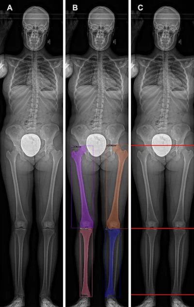 Схема измерения нижних конечностей проиллюстрирована с помощью репрезентативной рентгенограммы щелевого сканирования. Модель искусственного интеллекта была обучена сегментировать бедренную и большеберцовую кость: (A) исходная рентгенограмма и (B) та же рентгенограмма, показывающая сегментации (блоки), созданные моделью. (C) Сегментация B использовалась моделью для идентификации верхней части головки бедренной кости, медиального мыщелка большеберцовой кости и плафона большеберцовой кости (линии). Эти местоположения использовались моделью для измерения длины бедренной кости, большеберцовой кости и нижних конечностей в целом. Изображение предоставлено Радиологией.