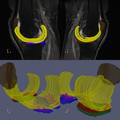 In the figure it is possible to see the images and ROIs used in this study: images were acquired using a sagittal intermediate-weighted turbo spin echo (TE = 30 ms, TR = 3,200 ms, FOV = 160 mm, Slice Thickness = 3 mm, In-plane Resolution = 0.36 mm × 0.51 mm, Bandwidth = 248 Hz/pixel, Matrix Size = 444 × 448 × 37). In yellow, the femoral cartilage, in brown, the patellar cartilage, in red, the medial meniscus, in green, the lateral TBL Cartilage, in blue, the medial TBL Cartilage, and in purple, the lateral meniscus. Image courtesy of Eros Montin, PhD.